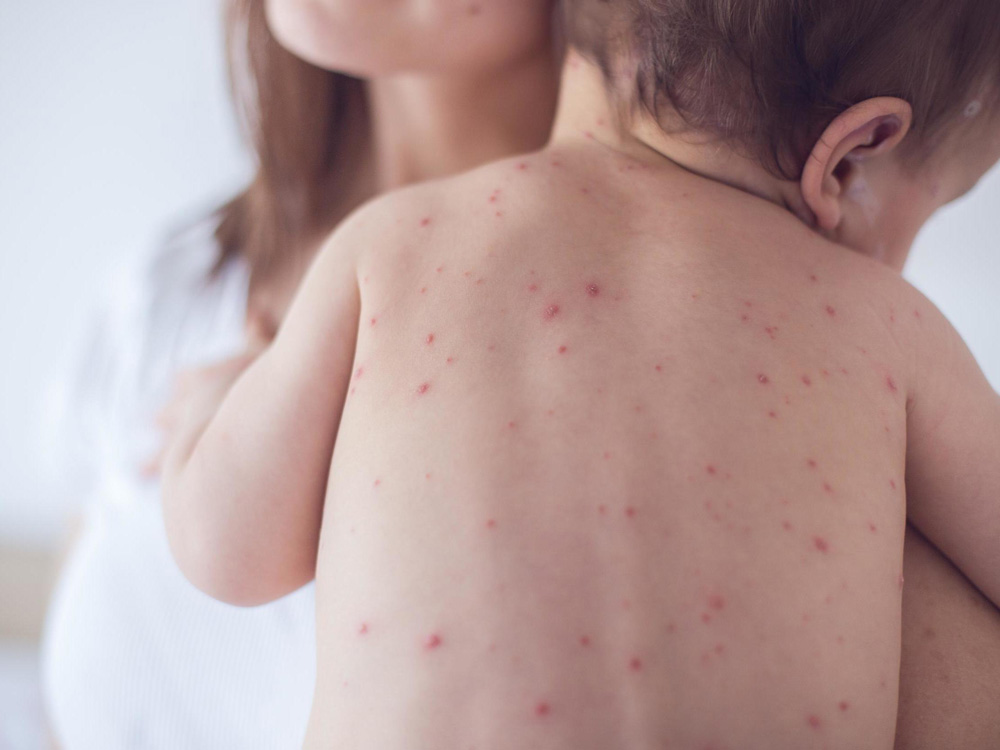 infant with measles